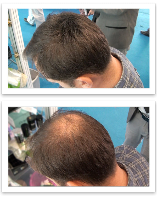 Before and after image of a man with straight brown hair with a bald spot on his crown